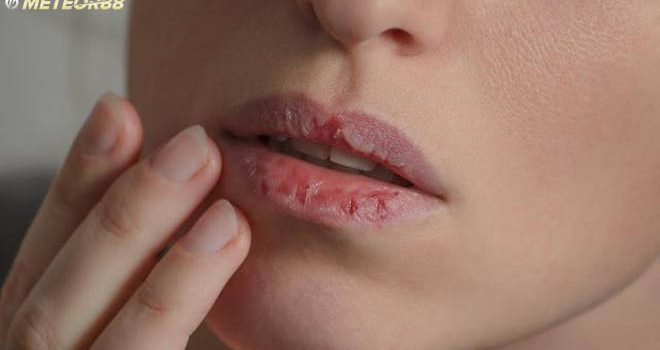 5 Hal Penyebab Bibir Kering Pecah - Pecah diBulan Puasa, Ini Penjelasannya